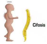 cifosis_congenita
