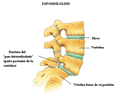 espondilolistesis