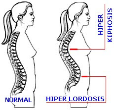 lordosis