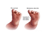 metatarso-varo-2-638