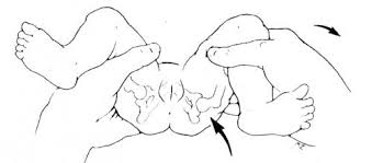 caderas-maniobra-barlow