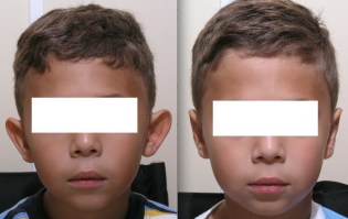 cirugia-de-orejas-en-ninos