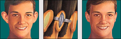 otoplastia