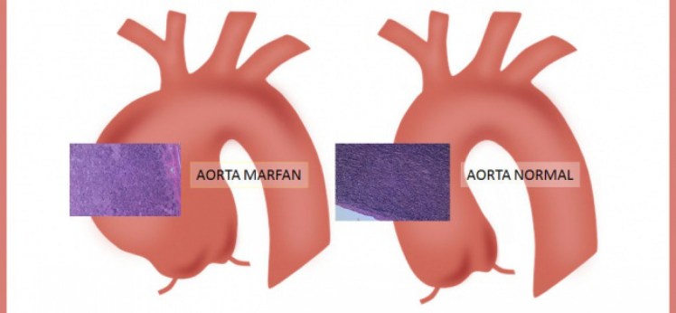 aorta marfan